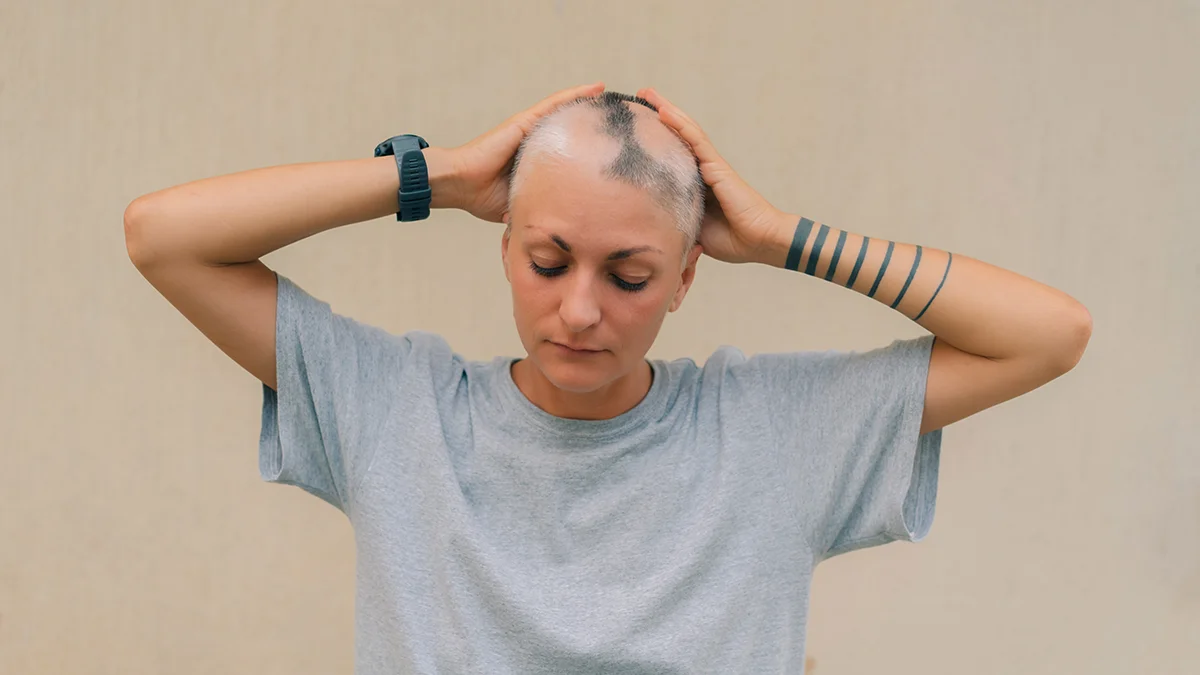 An urban young woman ina  grey T-shirt toucing her semi-bald head with alopecia areata